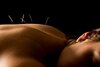 bigstockAcupuncture3083298.Home@CaseyRemedial-image-660x0-1-f9e.jpg